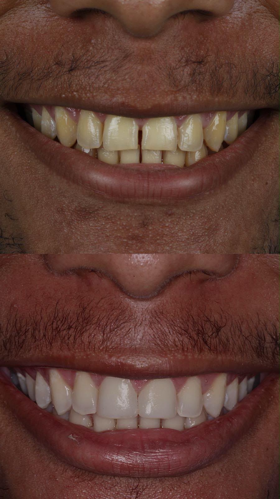 Facetas em porcelana — antes e depois
