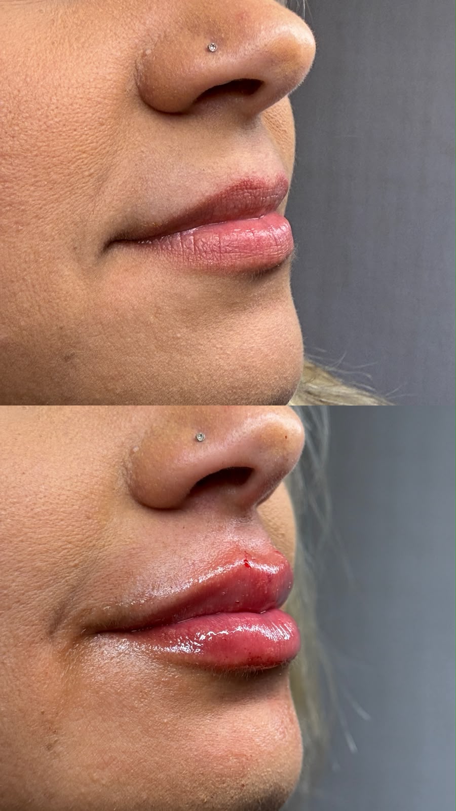 Harmonização labial — antes e depois