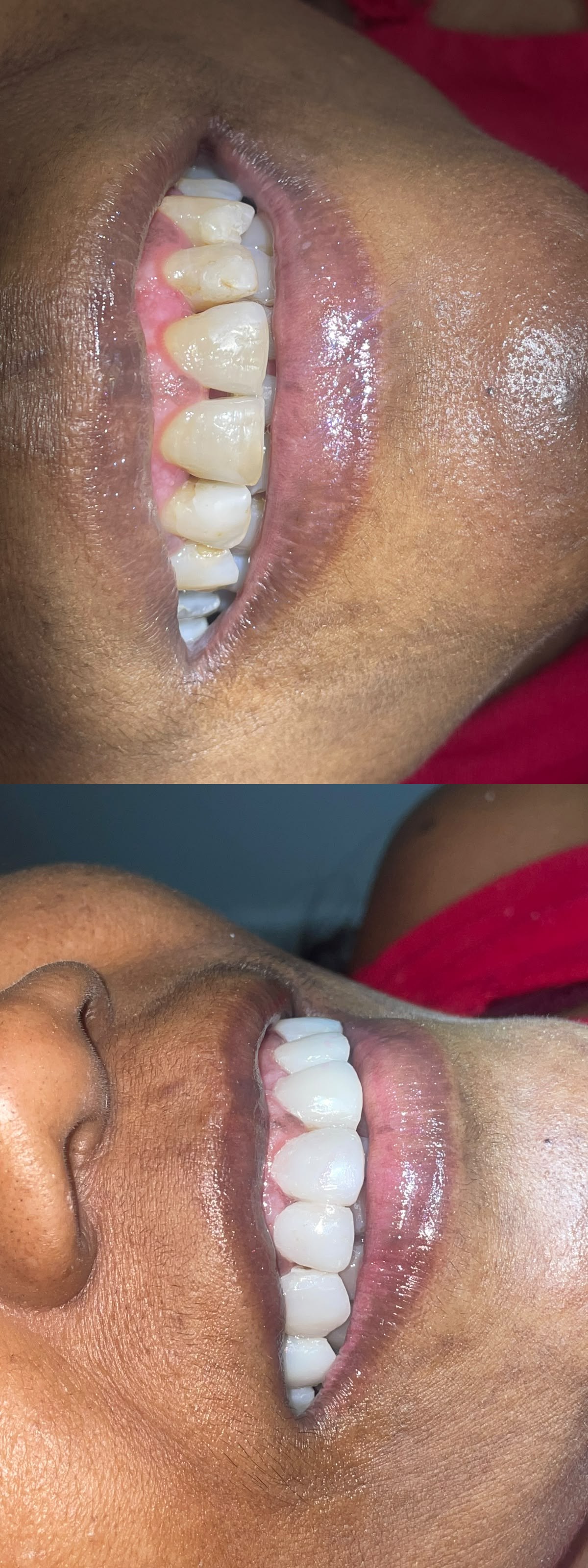 Lentes de contato dental — antes e depois