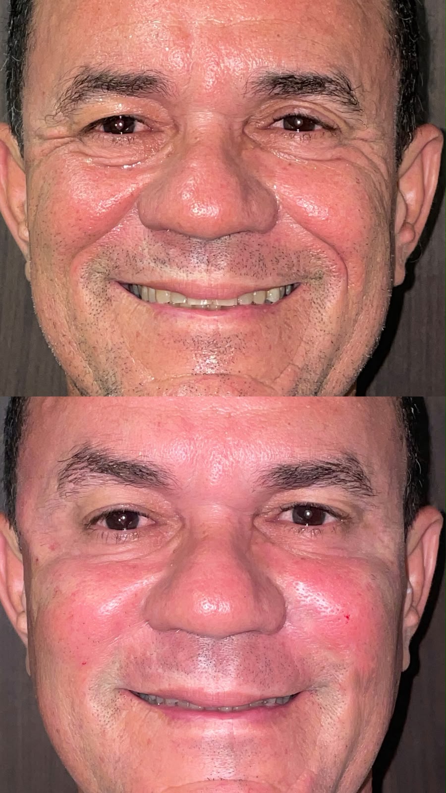 Reabilitação do sorriso — antes e depois